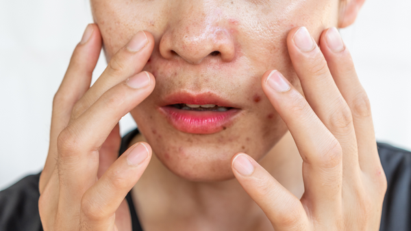 What You Should Do If Your Skin Is Still Oily In The Wintertime?